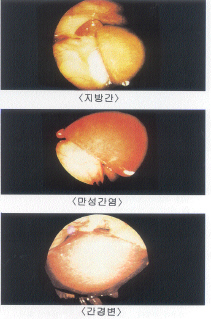 내부의 적 지방간,콜레스테롤 3